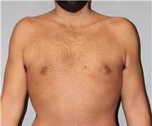 Male Breast Reduction After Photo by Keyian Paydar, MD, FACS; Newport Beach, CA - Case 46876