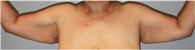 Arm Lift Before Photo by Keyian Paydar, MD, FACS; Newport Beach, CA - Case 46969