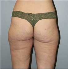 Thigh Lift Before Photo by Keyian Paydar, MD, FACS; Newport Beach, CA - Case 46990