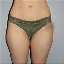 Thigh Lift Before Photo by Keyian Paydar, MD, FACS; Newport Beach, CA - Case 46990