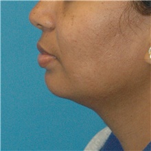 Chin Augmentation Before Photo by Scott Sattler, MD,  FACS; Seattle, WA - Case 47086