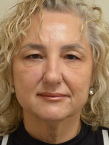 Facelift Before Photo by Mark McRae, MD, FRCS(C); Burlington, ON - Case 47227