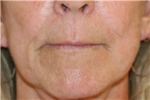 Lip Augmentation/Enhancement Before Photo by Steve Laverson, MD, FACS; Rancho Santa Fe, CA - Case 47254