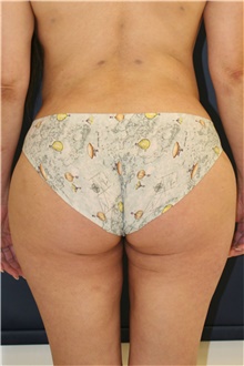 Buttock Lift with Augmentation After Photo by Steve Laverson, MD, FACS; Rancho Santa Fe, CA - Case 47256