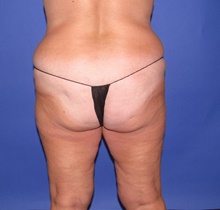 Thigh Lift Before Photo by Katerina Gallus, MD, FACS; San Diego, CA - Case 47402