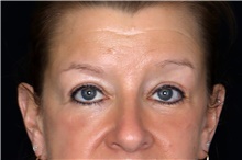 Eyelid Surgery After Photo by Landon Pryor, MD, FACS; Rockford, IL - Case 47462