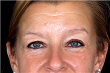 Eyelid Surgery Before Photo by Landon Pryor, MD, FACS; Rockford, IL - Case 47462