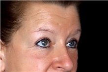 Eyelid Surgery After Photo by Landon Pryor, MD, FACS; Rockford, IL - Case 47462