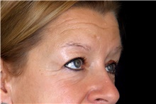 Eyelid Surgery Before Photo by Landon Pryor, MD, FACS; Rockford, IL - Case 47462