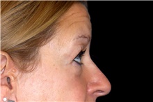 Eyelid Surgery Before Photo by Landon Pryor, MD, FACS; Rockford, IL - Case 47462