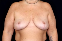 Breast Implant Removal After Photo by Landon Pryor, MD, FACS; Rockford, IL - Case 47467