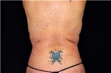 Body Lift Before Photo by Landon Pryor, MD, FACS; Rockford, IL - Case 47471