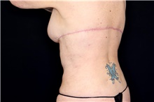 Body Lift After Photo by Landon Pryor, MD, FACS; Rockford, IL - Case 47471