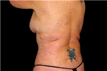 Body Lift Before Photo by Landon Pryor, MD, FACS; Rockford, IL - Case 47471