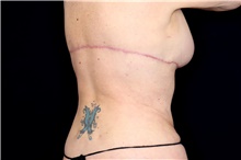 Body Lift After Photo by Landon Pryor, MD, FACS; Rockford, IL - Case 47471