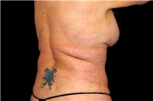 Body Lift Before Photo by Landon Pryor, MD, FACS; Rockford, IL - Case 47471