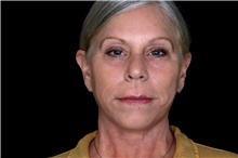 Facelift After Photo by Landon Pryor, MD, FACS; Rockford, IL - Case 47544