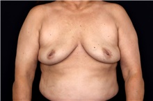 Breast Implant Removal After Photo by Landon Pryor, MD, FACS; Rockford, IL - Case 47547