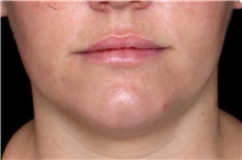 Dermal Fillers After Photo by Landon Pryor, MD, FACS; Rockford, IL - Case 47553