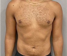 Male Breast Reduction After Photo by Keshav Magge, MD; Bethesda, MD - Case 47615