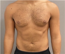 Male Breast Reduction Before Photo by Keshav Magge, MD; Bethesda, MD - Case 47615