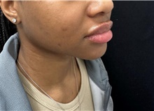 Lip Augmentation/Enhancement After Photo by David Rapaport, MD; New York, NY - Case 47644