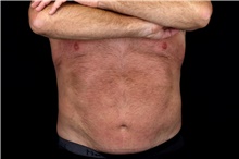 Liposuction After Photo by Landon Pryor, MD, FACS; Rockford, IL - Case 47700