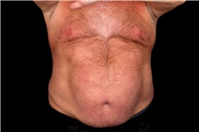 Liposuction Before Photo by Landon Pryor, MD, FACS; Rockford, IL - Case 47700