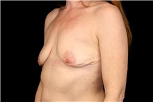 Breast Implant Removal After Photo by Landon Pryor, MD, FACS; Rockford, IL - Case 47719