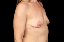 Breast Implant Removal After Photo by Landon Pryor, MD, FACS; Rockford, IL - Case 47719