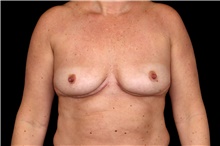 Breast Implant Removal After Photo by Landon Pryor, MD, FACS; Rockford, IL - Case 47720