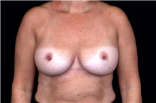 Breast Implant Removal Before Photo by Landon Pryor, MD, FACS; Rockford, IL - Case 47720