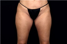 Thigh Lift After Photo by Landon Pryor, MD, FACS; Rockford, IL - Case 47739