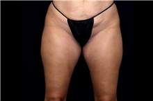 Thigh Lift Before Photo by Landon Pryor, MD, FACS; Rockford, IL - Case 47739