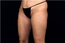 Thigh Lift After Photo by Landon Pryor, MD, FACS; Rockford, IL - Case 47739