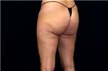 Thigh Lift After Photo by Landon Pryor, MD, FACS; Rockford, IL - Case 47739