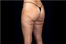 Thigh Lift Before Photo by Landon Pryor, MD, FACS; Rockford, IL - Case 47739