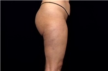 Thigh Lift After Photo by Landon Pryor, MD, FACS; Rockford, IL - Case 47739