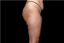 Thigh Lift Before Photo by Landon Pryor, MD, FACS; Rockford, IL - Case 47739