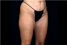 Thigh Lift Before Photo by Landon Pryor, MD, FACS; Rockford, IL - Case 47739