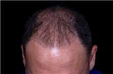 Hair Transplant After Photo by Landon Pryor, MD, FACS; Rockford, IL - Case 47748