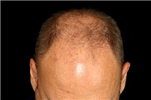 Hair Transplant Before Photo by Landon Pryor, MD, FACS; Rockford, IL - Case 47748