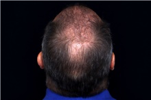 Hair Transplant After Photo by Landon Pryor, MD, FACS; Rockford, IL - Case 47748