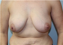 Breast Reconstruction Before Photo by Caleb Steffen, MD; Jefferson City, MO - Case 47860