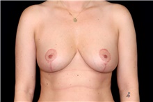 Breast Reduction After Photo by Landon Pryor, MD, FACS; Rockford, IL - Case 47875