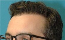 Hair Transplant After Photo by Scott Sattler, MD,  FACS; Seattle, WA - Case 47879