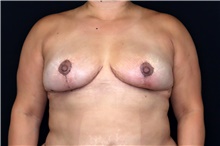 Breast Implant Removal After Photo by Landon Pryor, MD, FACS; Rockford, IL - Case 47883