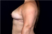 Breast Implant Removal After Photo by Landon Pryor, MD, FACS; Rockford, IL - Case 47883