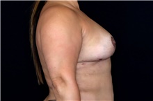 Breast Implant Removal After Photo by Landon Pryor, MD, FACS; Rockford, IL - Case 47883