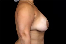 Breast Implant Removal Before Photo by Landon Pryor, MD, FACS; Rockford, IL - Case 47883